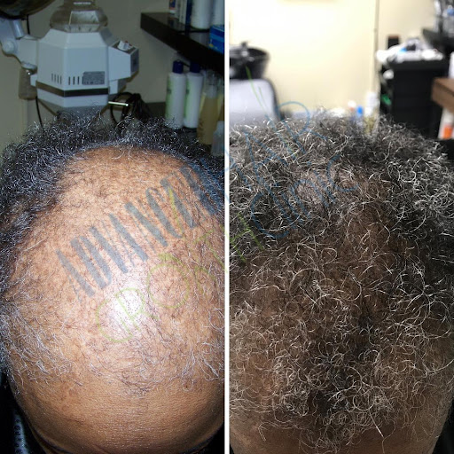 Advanced Hair Growth Clinic VA