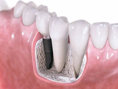 Dental implants provider Henderson