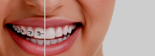 Clear Aligners Dental Clinic - Invisalign Provider