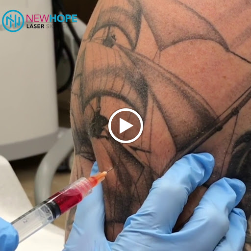 Explore lung cancer tattoo ideas, creative tattoo ideas in Westminster, available at Newhope Laser Skin Care