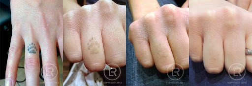 Explore geology tattoo ideas, creative tattoo ideas in Minneapolis, available at Renewal Laser Clinic