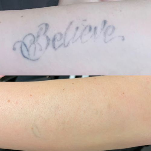 Comments and reviews of Erasing Ink - The Preston Laser Clinic