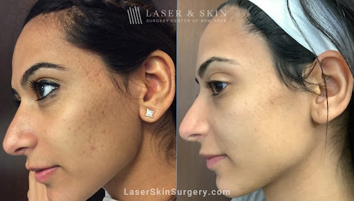 Explore female tattoo ideas ribs, creative tattoo ideas in Southampton, available at Laser & Skin Surgery Center of New York - Southampton