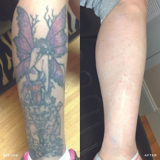 Explore rhino tattoo ideas, creative tattoo ideas in Glen Mills, available at Removery Tattoo Removal & Fading