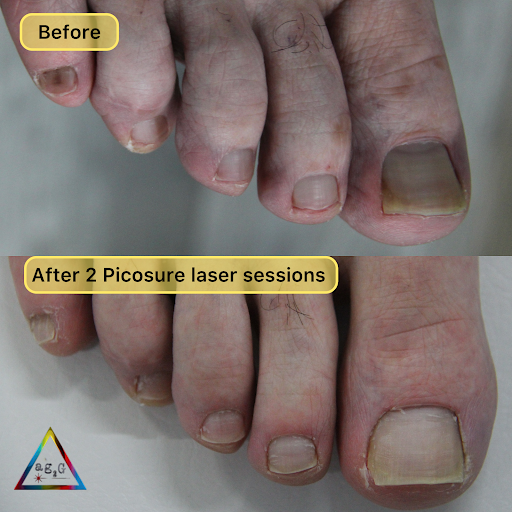 Explore small paw print tattoo ideas, creative tattoo ideas in New York, available at Ag2g Laser Tattoo Removal & MedSpa