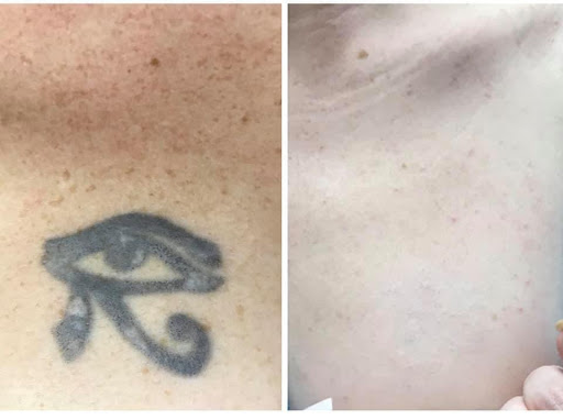 Explore scorpio sign tattoo ideas, creative tattoo ideas in Pinellas Park, available at St Pete Tattoo Removal