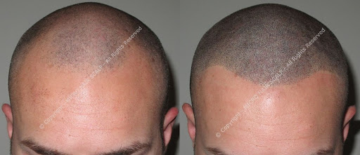 Micro Hair Scalp Hair pigmentation Permanent