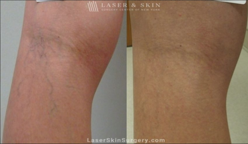 Explore spider web tattoo ideas, creative tattoo ideas in Southampton, available at Laser & Skin Surgery Center of New York - Southampton