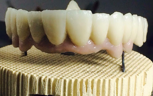 Implantes Dentales La Paz Bolivia