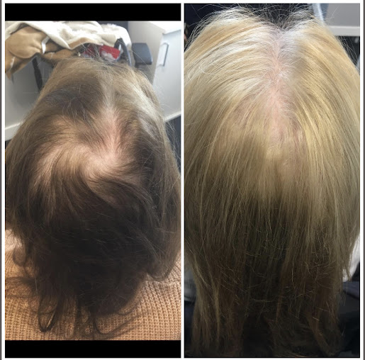 عيادات تساقط الشعر - كارلايل - The Hair Loss Clinics - Carlisle