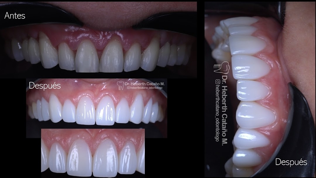 Heberth Cataño implantes dentales & rehabilitación oral & estetica Tuluá