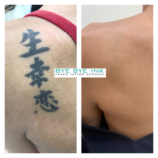 Explore ring tattoo cover up ideas, creative tattoo ideas in Middle Village, available at Bye Bye Ink Laser Tattoo Removal