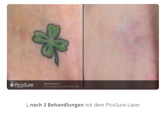 tattooentfernung-kreuzlingen.ch