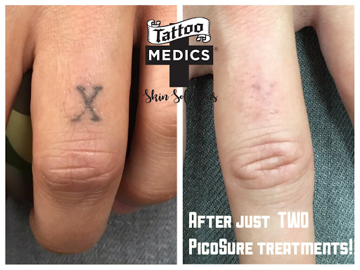 Find bubble tattoo ideas for your next unique tattoo in Providence at TattooMedics Laser Tattoo Removal