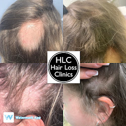 Leicester Hair Loss Clinic