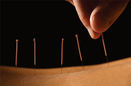 Acupuncture Donegal - Natural Health Centre Buncrana in Buncrana, Co. Donegal (Dún na nGall)