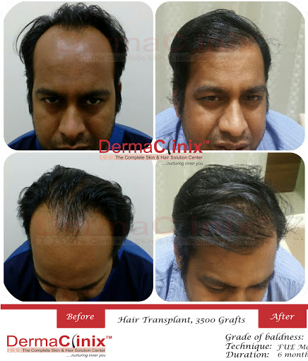 Dr Kavish Chouhan, MD - Best Dermatologist, Hair Transplant Surgeon in India