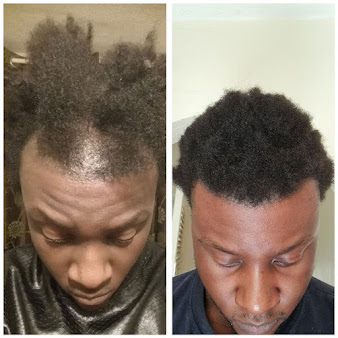 عيادات أفضل لزراعة الشعر - برمنغهام - Better Hair Transplant Clinics - Birmingham