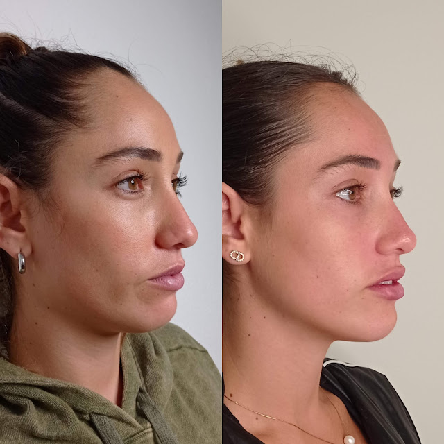 AESTHETIC DOCTORS - (Botox, Hialurónico, Sculptra, VENUS, Bioestimulación, Enzimas & más..)