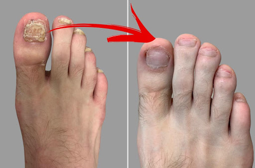 Fungal Toenail Laser Therapy Fungus Treatment - Dr. Michael Horwitz, DPM - St. Louis