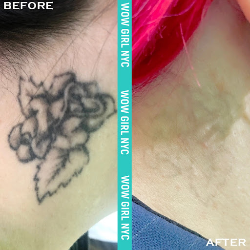 Explore new beginning tattoo ideas, creative tattoo ideas in New York, available at WOW LASER NYC Tattoo removal in New York