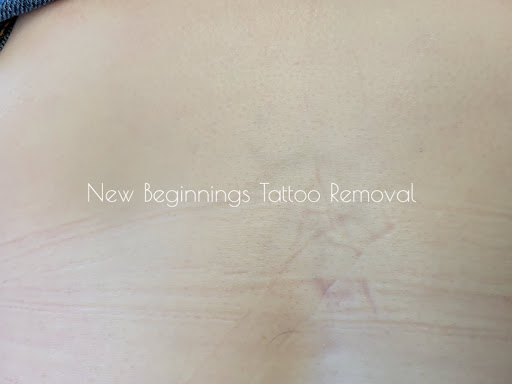 Explore alabama tattoo ideas, creative tattoo ideas in Arvada, available at New Beginnings Tattoo Removal