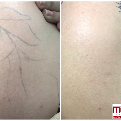 Explore dmt tattoo ideas, creative tattoo ideas in San Antonio, available at MEDermis Tattoo Removal