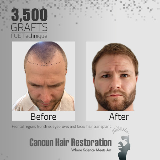 Cancun Hair Restoration - Best Hair Transplant in Mexico