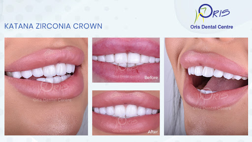 Oris Dental Center - Jumeirah, Dental Implants, Dental Veneers & Hollywood Smile Specialist