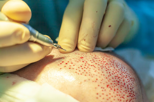 Ziering Medical Hair Restoration Beverly Hills image