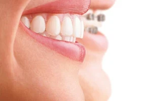 Invisalign | Clínica Max Dental Móstoles | Implantes | Blanqueamiento Dental image