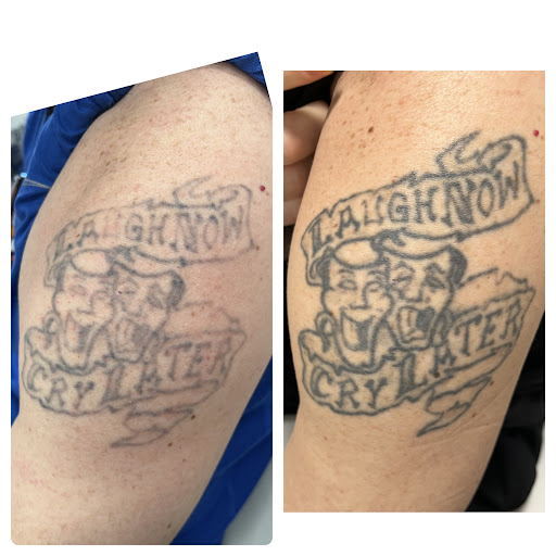 Explore black tattoo ideas for women, creative tattoo ideas in Orlando, available at Laser Procedure of Florida