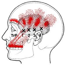 Temporalis muscle