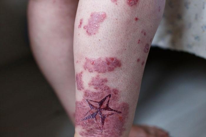 Signs and symptoms of tattoo infection (and what to do about it)