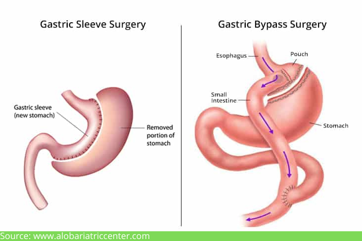 D:\Digicore\UNOSEARCH\Dr Harsh Sheth - Bariatric Surgeon\Gastric Sleeve Weight Loss Surgery\Source Difference-Between-Gastric-Sleeve-Surgery-and-Gastric-Bypass-Surgery.jpg