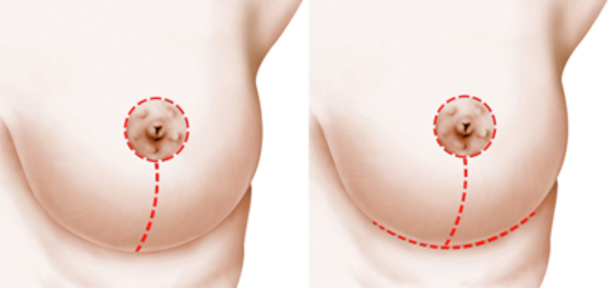 breast incisions