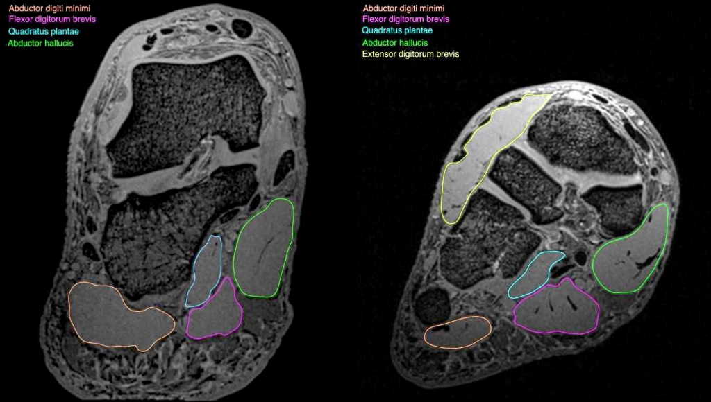 Foot Muscles Mri - Foot Radiological Anatomy Shorouk Zaki / Muscle mri