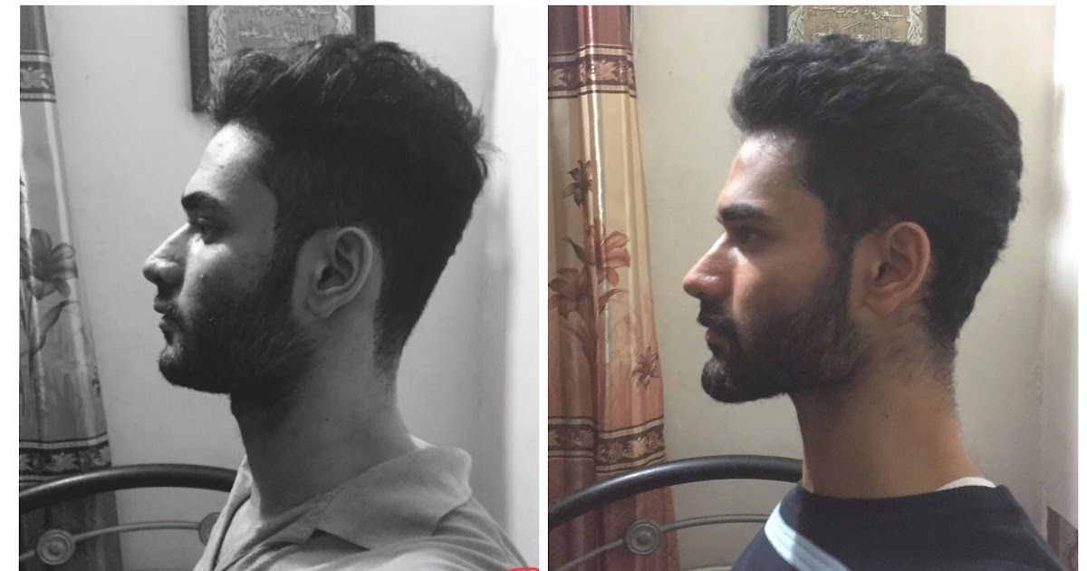 How To Fix Forward Head Posture Reddit / How To Fix Forward Head