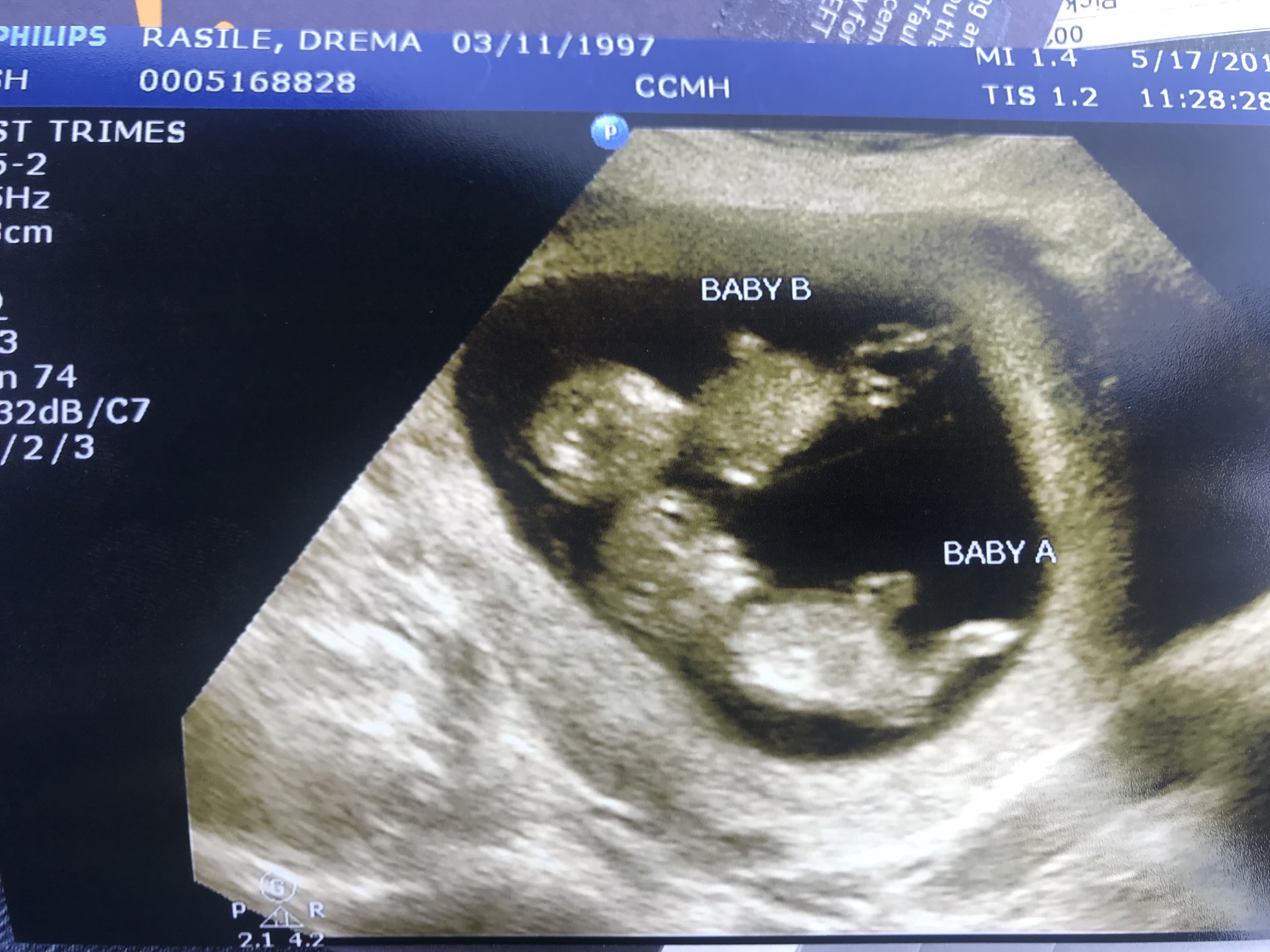 Images ultrasound twin pregnancy Unbelievable ultrasound