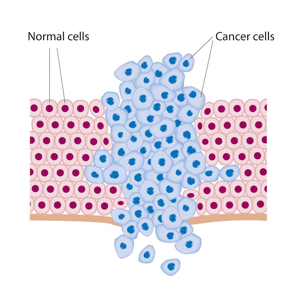 Tumor Cartoon - Typically, these tumors are small, poorly