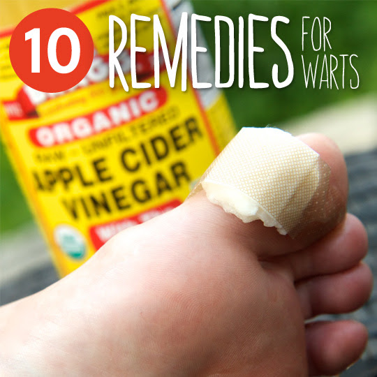10 Natural Remedies for Warts- so you can get rid of your warts at home without using harsh chemicals and treatments.