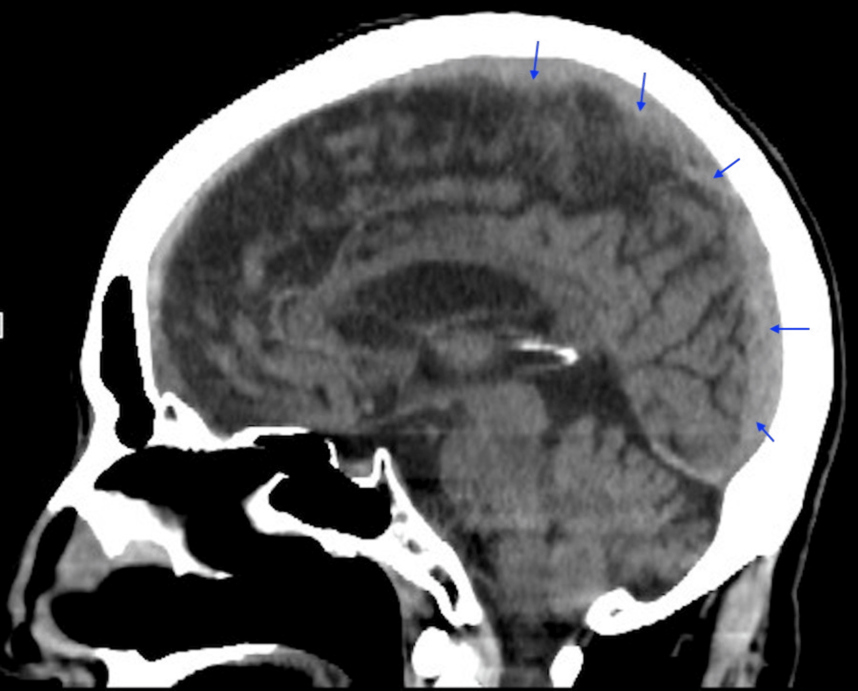 Acute-on-Chronic Subdural Hematoma Secondary to Falls Due to Alcoholism