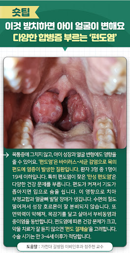 소아급성비염(코감기) 증상(콧물, 코막힘)과 합병증(만성비염, 부비동염, 축농증, 중이염, 편도염), 치료방법