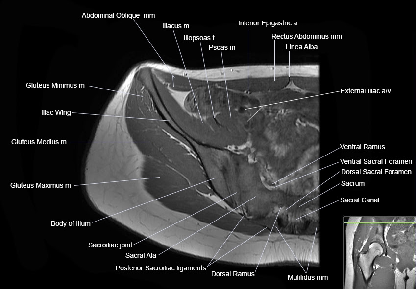 Pelvic Anatomy Ct