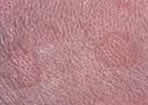 cat skin picture wheal