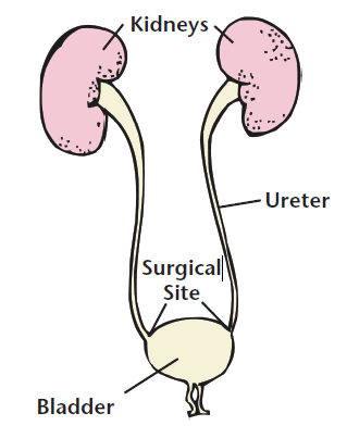 reimplantation kidney ureteral hernia bladder ureter urinary reflux ovulation