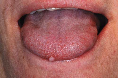 Papilloma virus del cane Papilloma sulla lingua del cane