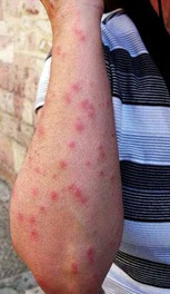 Bed bug bites Bed bug bites