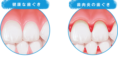 歯肉炎とは？