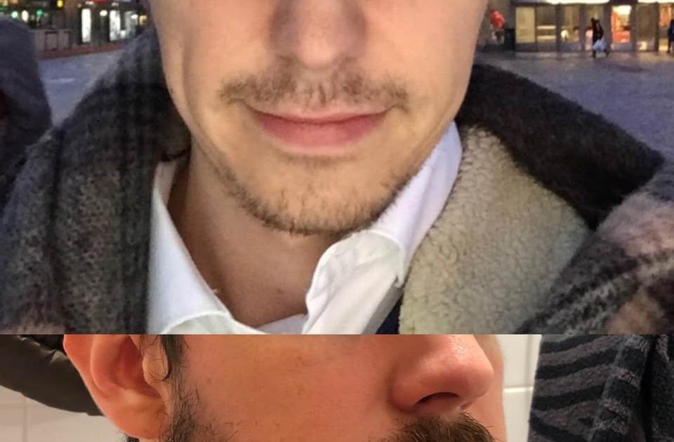 Minoxidil Before And After Beard Result : 17 Before-And-After Pics That